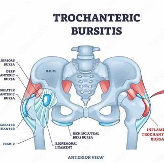 Greater Trochanteric Pain Syndrome (GTPS): What It Is & How Physiotherapy Can Help
